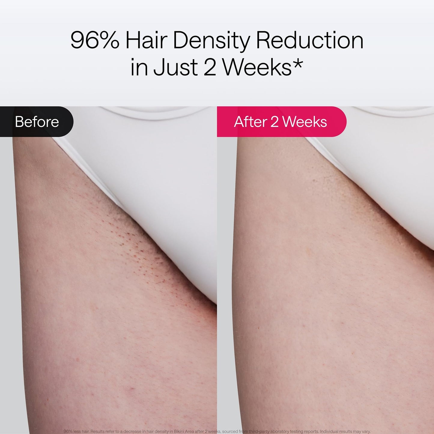 Air 10 IPL Hair Removal Device with Ice Cooling Technology – Permanent, Painless At-Home Treatments for Women and Men